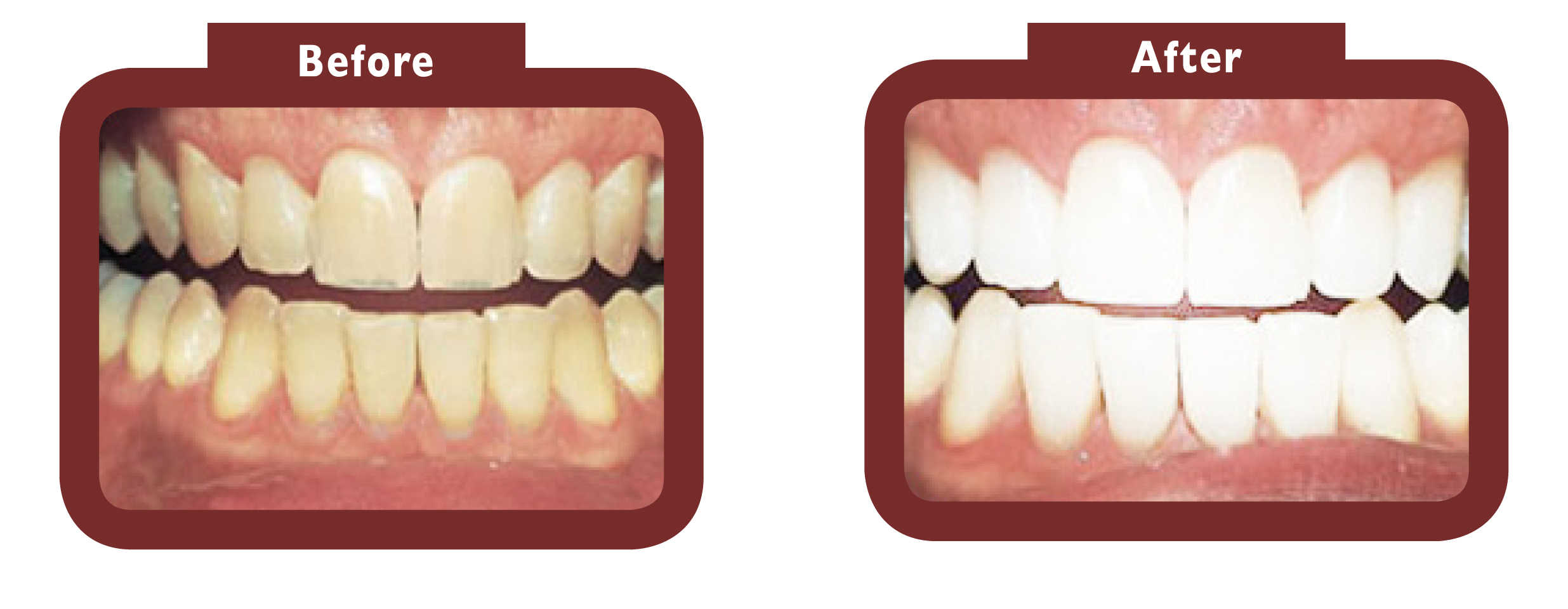 before and after teeth whitening - LA TEETH Corby