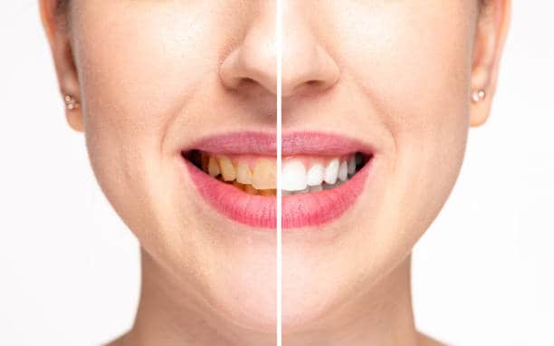 Teeth Whitening Milton Keynes Corby