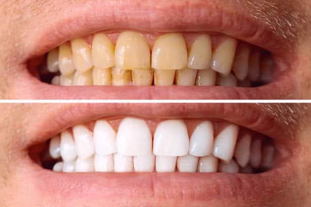 Laser White For Ever Bright – Get a Brighter, Whiter Smile with LA Teeth Whitening Corby