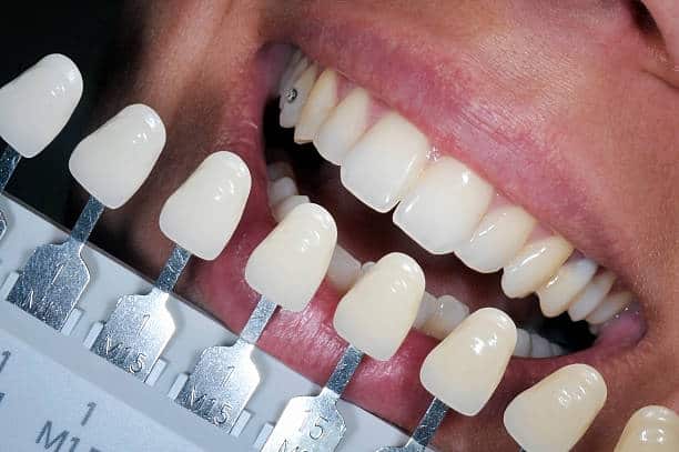 Get Natural and Stunning Smile with Teeth Whitening Results from LA Teeth Whitening Corby