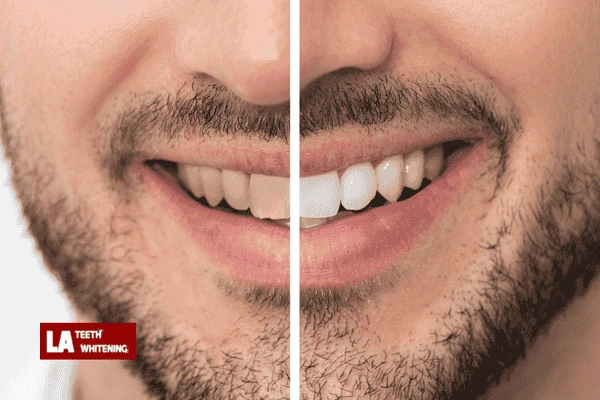 How Many Laser Whitening Treatments Are Needed? Corby