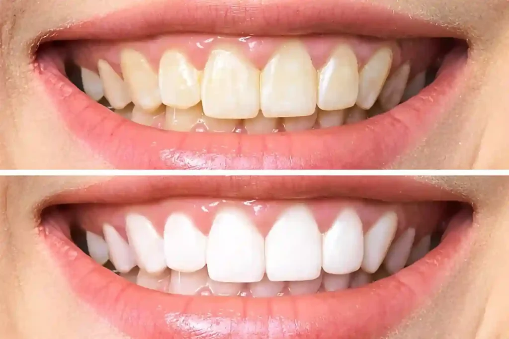 A before-and-after image showing gradual whitening results on teeth, maintaining a natural look Corby